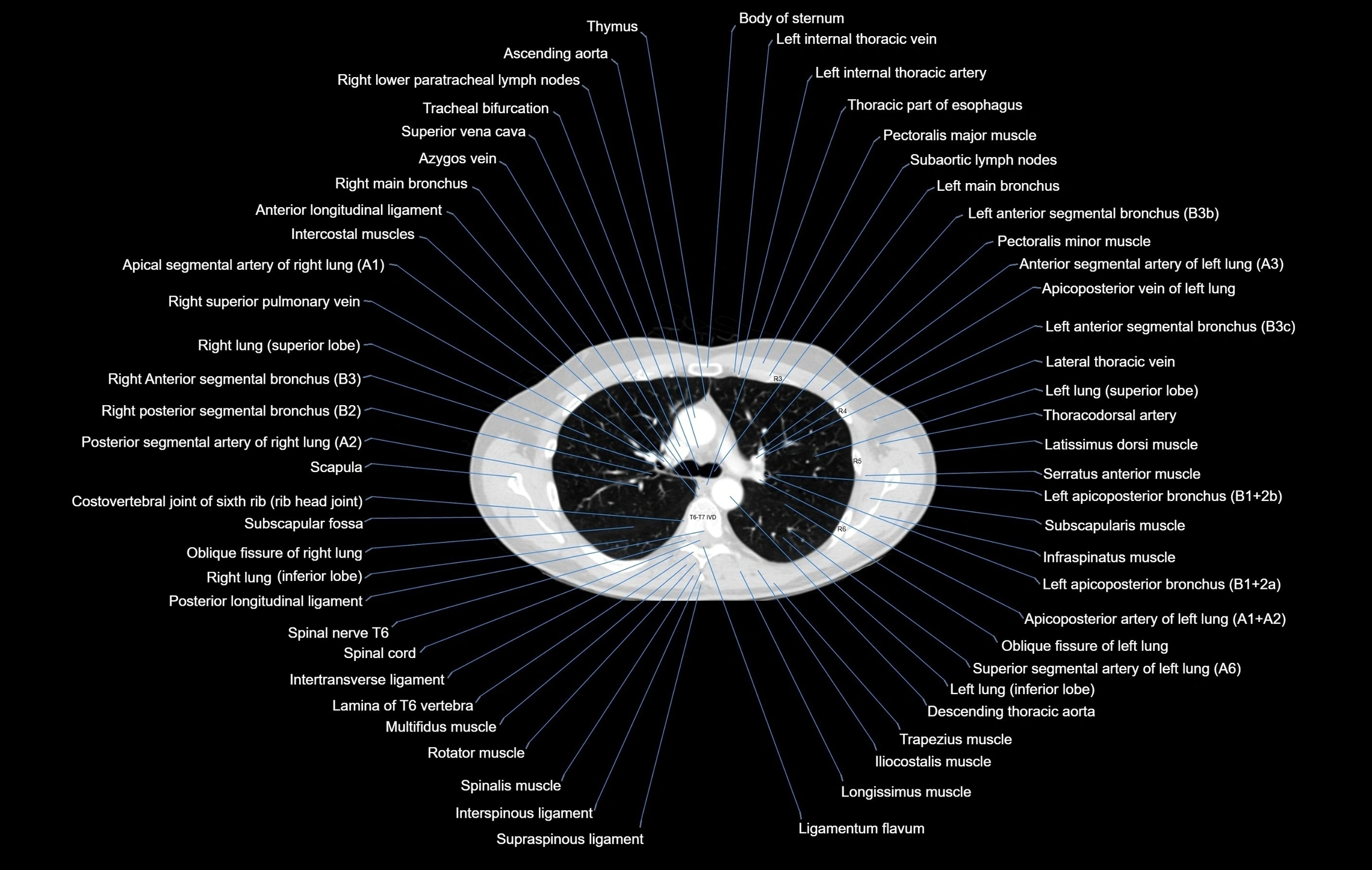 CT chest (thorax) labelled axial cross sectional anatomy radiology image-00047.webp